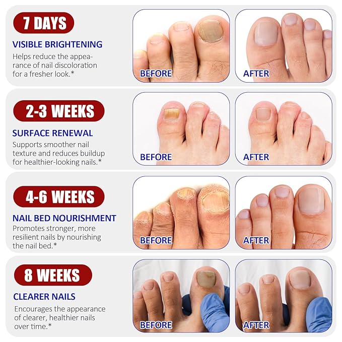 Toenail Treatment Extra Strength, 64 Pcs Nail Patches 8-Hour Overnight Nail Fast Acting Repair for Damaged, Resolve Thick, Discolored Nails, Foot Nails Repair & Care, Maintain Nail Balance