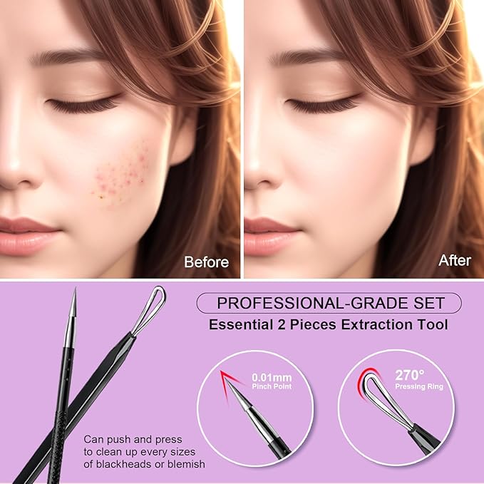 Teenitor Pimple Extractor Tool Comedone Extractor Acne Tool Blackhead Removal Tool 2-in-1 Pimple Popper Tool for Face and Nose Black