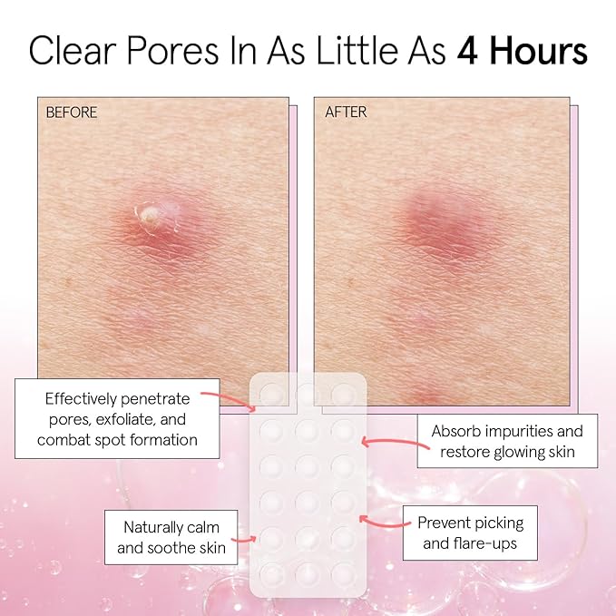 grace & stella Award Winning Pore Strip - Pimple Patches for Face - Hydrocolloid Acne Patches for Shrinking Zits, Breakouts - Spot Stickers - Dermatologist-Tested, Vegan (Invisible, 36 Count)