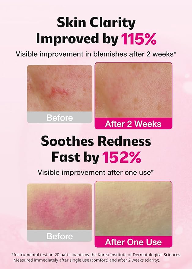 ISOI Blemish Care Up Serum for Face, Vegan Hydrating Serum for Smooth & Glass Skin Effect, Skin Barrier & Moisture Balance for Women, Arbutin & Rose Otto Oil, Korean Skin Care (1.18 fl. oz, 35ml)