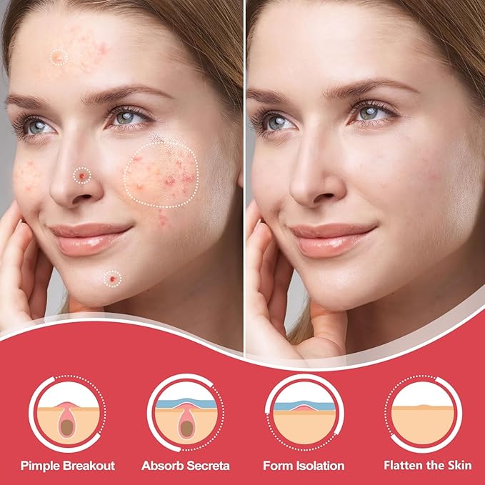 432 Counts Pimple Patches for Face, Hydrocolloid Acne Patches Zit Patches for Face Acne Spot Treatment Patch Cystic Acne Treatment Stickers Blemish Hydrocolloid Patches for all Skin Type