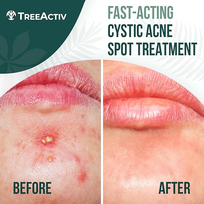 TreeActiv Cystic Acne Spot Treatment, Hormonal & Overnight Sulfur Cystic Treatment For Face, Pimples, and Blemishes for Adults, Men, and Women - 0.5oz 120+ Uses