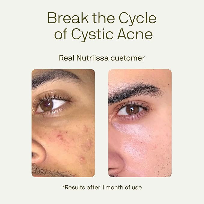 Nutriissa ACNEtane - Hormonal & Cystic Acne Control with Pantothenic Acid & L-Carnitine - EPEB Certified for Purity & Potency - 120 Vegan Capsules