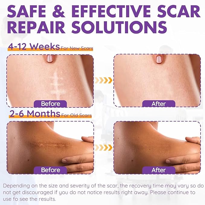 Silicone Scar Sheets, Silicone Scar Tape(1.6"x 118" Roll-3M), Reusable Professional Scar Silicone Strips, Soft Silicone Scar Sheets for Surgical Scars,Keloid,Acne Scars,Burn Scar,C-Section