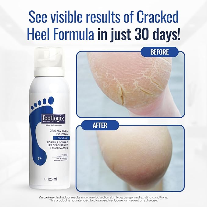 FOOTLOGIX Cracked Heel Formula, White 4.23 Ounce