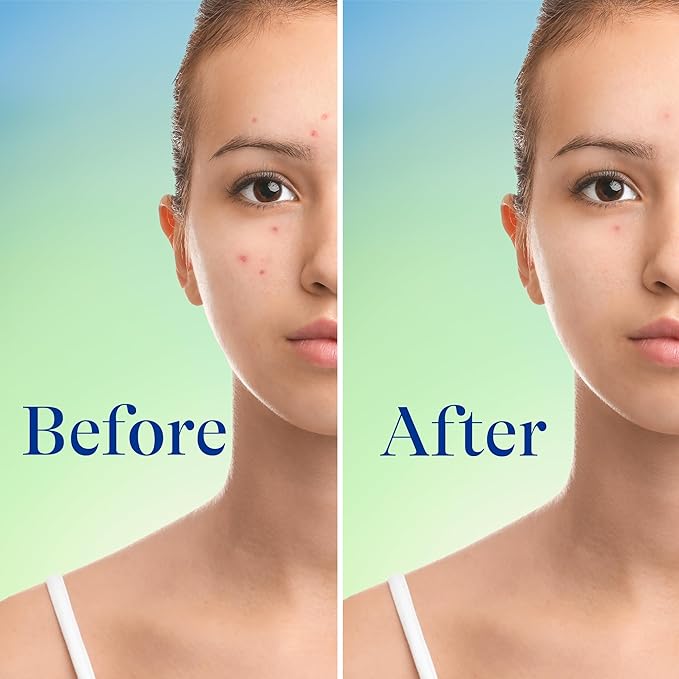 Differin Acne Face Wash with 10% Benzoyl Peroxide, Maximum Strength OTC Acne Foaming Cleanser, Fast Acting Acne Treatment for Face and Body, 5 oz.
