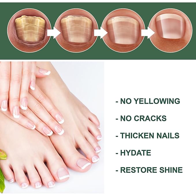 Cure nail Fungus Treatment Extra Strength,Gray Nail Liquid External Use Health Care Hand and Foot Thickening Brightening Gray Nail Foot Care Liquid，30ml/pcs