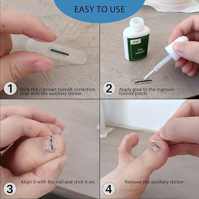 10-Piece Pack Titanium Alloy Ingrown Toenail Corrector,Curved Toenail Repair Patch,Memory Metal Ingrown Toenail Physical Correction Tool,Ingrown Toenail Removal Tool Set,Nail Aesthetic Shaping Tools.