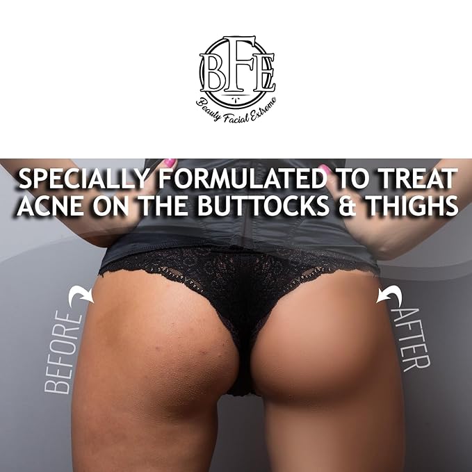 Anti-Acne Buttocks & Thigh Treatment- Clears Away Acne, Pimples, Zits, Dark Spots & Ingrown Hairs on the Buttocks &Thigh Area. Prevents Future Breakouts 6.9 OZ