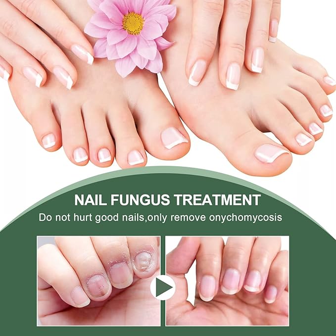Cure nail Fungus Treatment Extra Strength,Gray Nail Liquid External Use Health Care Hand and Foot Thickening Brightening Gray Nail Foot Care Liquid，30ml/pcs