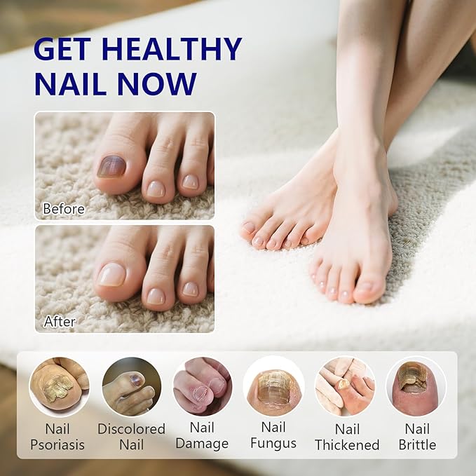 4-PACK Nail Fungus Pen - Toenail Fungus Treatment Extra Strength 25% Undecylenic Acid, Fast-Acting 7 Days Toe Nail Fungus Treatments, Tea Tree Oil, Acetic Acid Fungal Nail Repair Pens for Damaged Nail