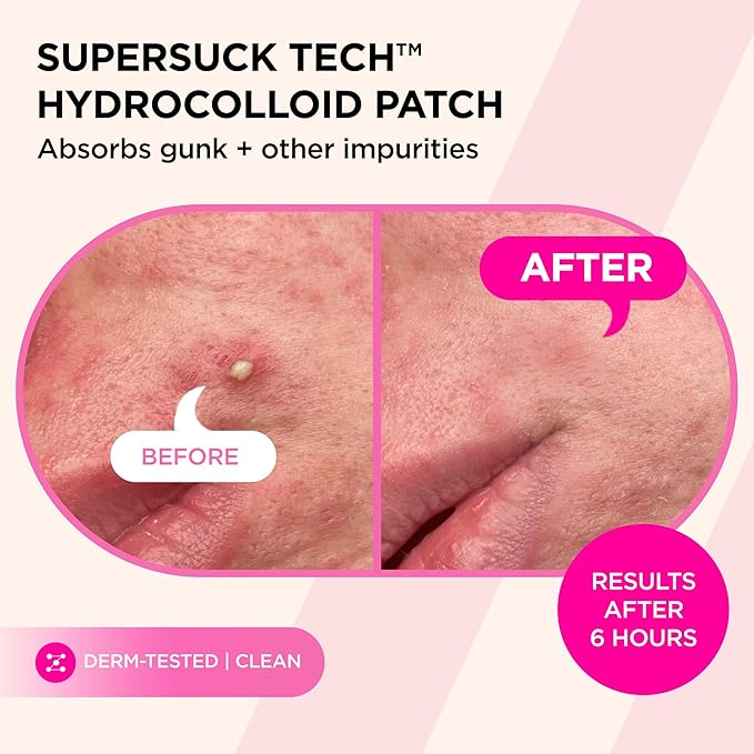ZitSticka Pimple Patches for Face and Body, Goo Getter Hydrocolloid Patches to Cover Zits & Blemishes, Acne Patches or Zit Spot Stickers, Body Blemish Patch (Sucks to be Goo 23 Pack)