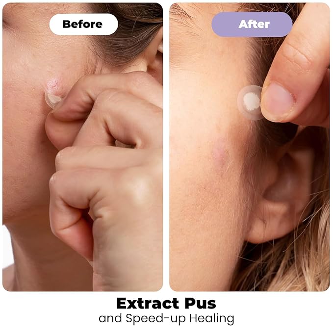 ROSELYNBOUTIQUE Pimple Patches for Face - Daytime Invisible+ Hydrocolloid Acne Patches For Zits Blemishes Pore Strips - Vegan Cruelty-Free Skincare Products Skin-Friendly (30 UltraThin 0.1mm)