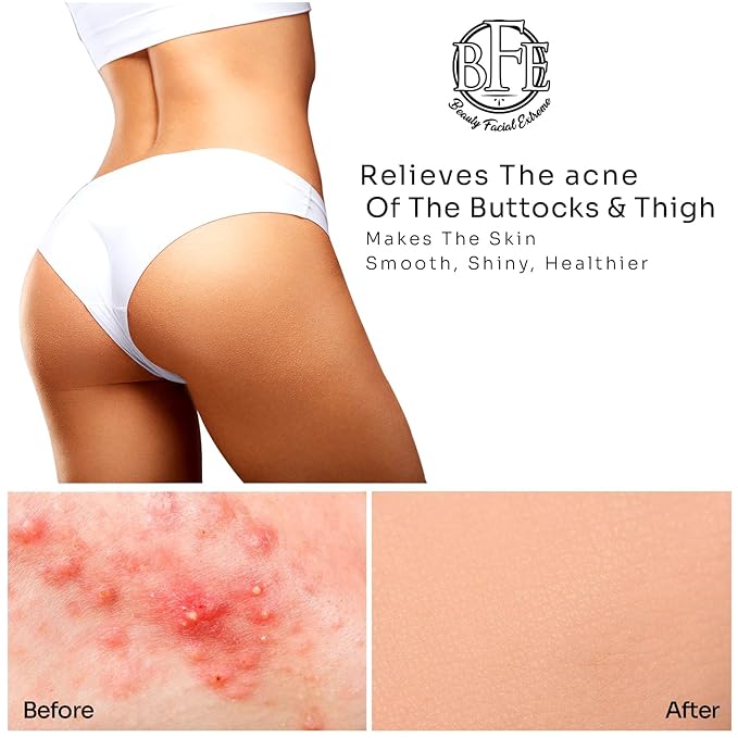 Anti-Acne Buttocks & Thigh Treatment- Clears Away Acne, Pimples, Zits, Dark Spots & Ingrown Hairs on the Buttocks &Thigh Area. Prevents Future Breakouts 6.9 OZ
