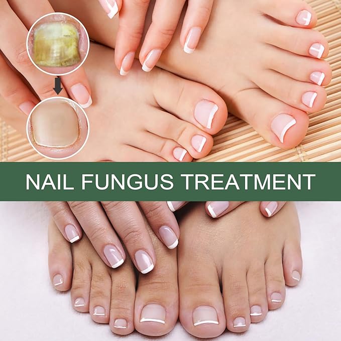 Cure nail Fungus Treatment Extra Strength,Gray Nail Liquid External Use Health Care Hand and Foot Thickening Brightening Gray Nail Foot Care Liquid，30ml/pcs