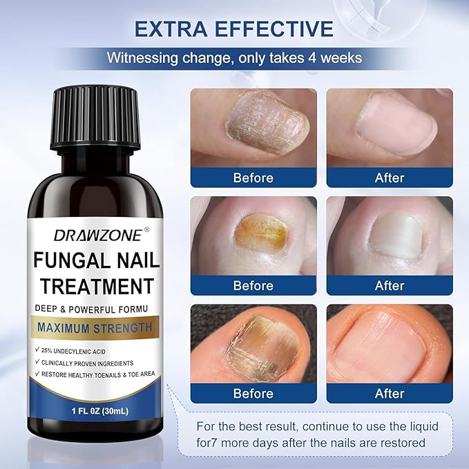 Toenail Fungus Treatment Extra Strength with 25% Undecylenic Acid, Ingrown toenail treatment, nail repair, Fungus nail treatment, yellow toenail, Damaged Nails foot fungus treatment （4Pack)