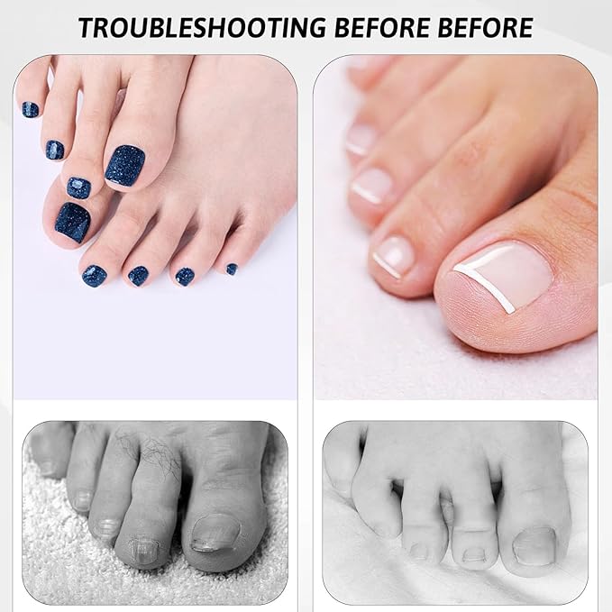 Professional Ingrown Toenail Corrector Set with Ingrown Toenail Strips, Curved Toenails Corrector Patch, Painless File and Lifter Pedicure Tools, Ingrowns Toenails Tools for Women and Man