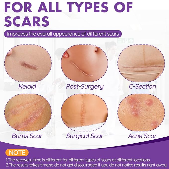 Silicone Scar Sheets, Silicone Scar Tape, Reusable Professional Scar Silicone Strips, Soft Silicone Scar Sheets for Surgical Scars,Keloid,Acne Scars,Burn Scar,C-Section (5M)