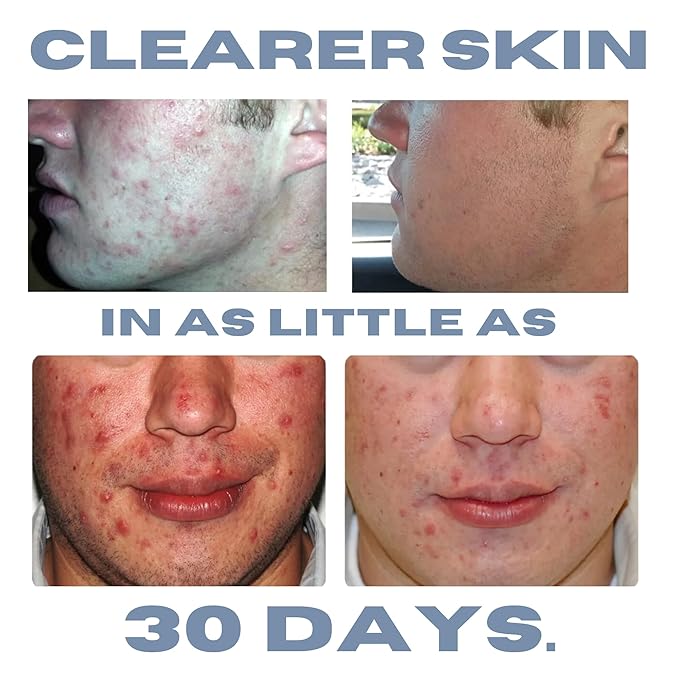 Clearogen Sensitive Skin Sulfur Acne Lotion, Acne Treatment, Sulfur Cream, Sulfur Ointment, Sulfur Spot Treatment, Sulfur Acne Treatment Cream 1.8 FL Oz