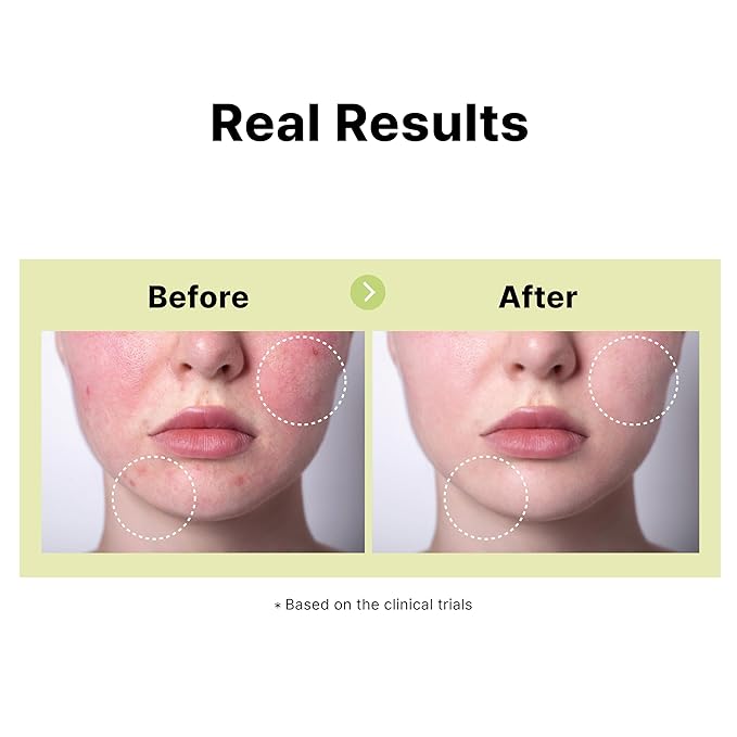 10% Azelaic Acid Serum with Niacinamide, Salicylic Acid, Allantoin, Rosacea Treatment for Face Redness Relief, Reduce Cystic Acne Scar, Pimples, Non-Comedogenic, Korean Skincare, 1Fl Oz