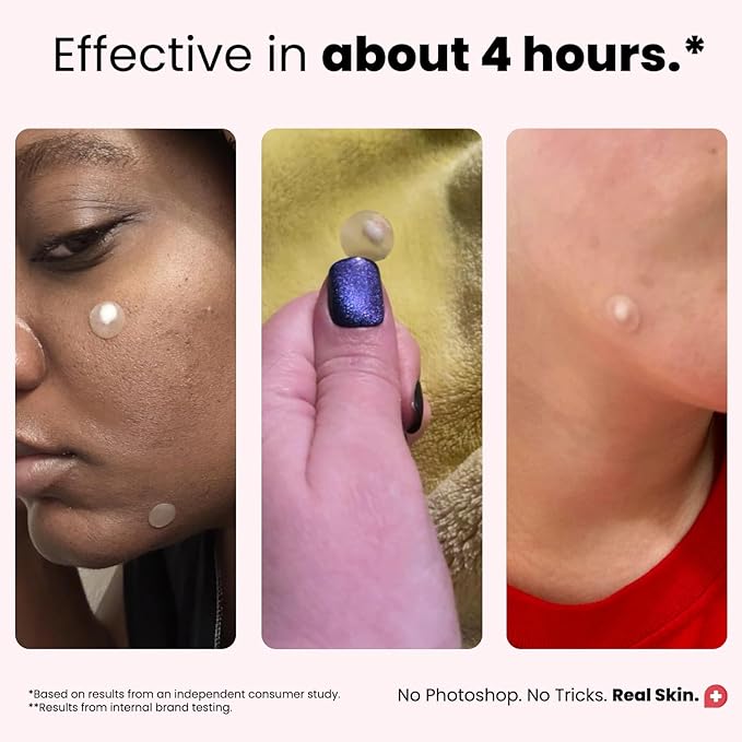 ROSELYNBOUTIQUE Pimple Patches for Face (60Ct - 4 Sizes 8,10,12,14mm) - Hydrocolloid Acne Spot Patches Blemishes Pore Strips - Vegan Facial Korean Skin Care Products Cruelty-Free (60 Dots)