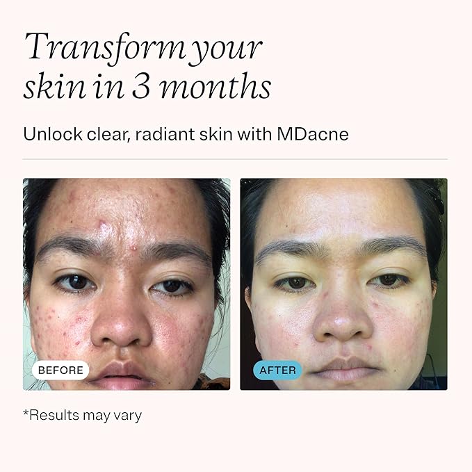 MDacne - Acne Treatment- Benzoyl Peroxide Cream 2.5% - Unclogs Pores, Reduces Blemishes & Enhanced with - Plant-Based Ingredients for Sensitive Skin