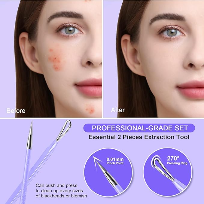 Teenitor Pimple Extractor Acne Treatment Tool Blackhead Comedone Removal 2-in-1 Popper Tool for Face Blackhead Extractor Tool Purple