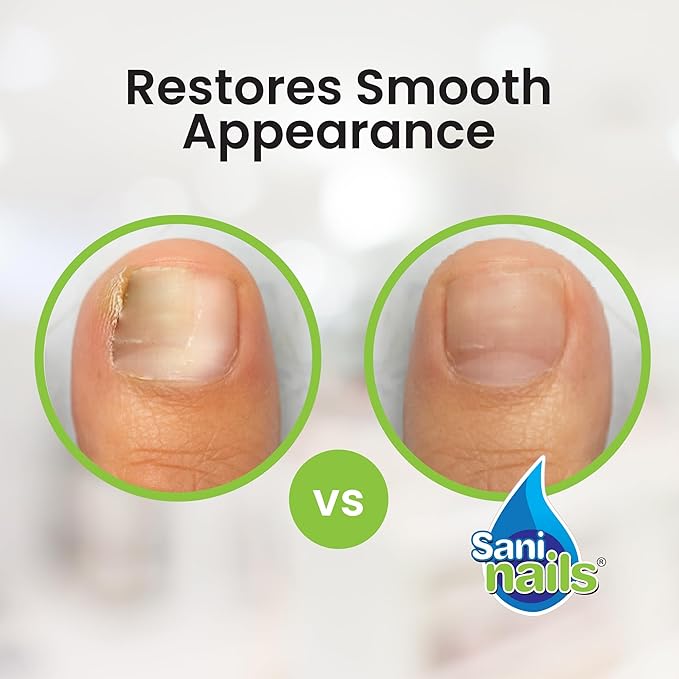 Troya Toenail Repair For Damaged Nails – Sani Nails Brush-On Toenail Solution for Hydrating and Restoring (1 Pack)