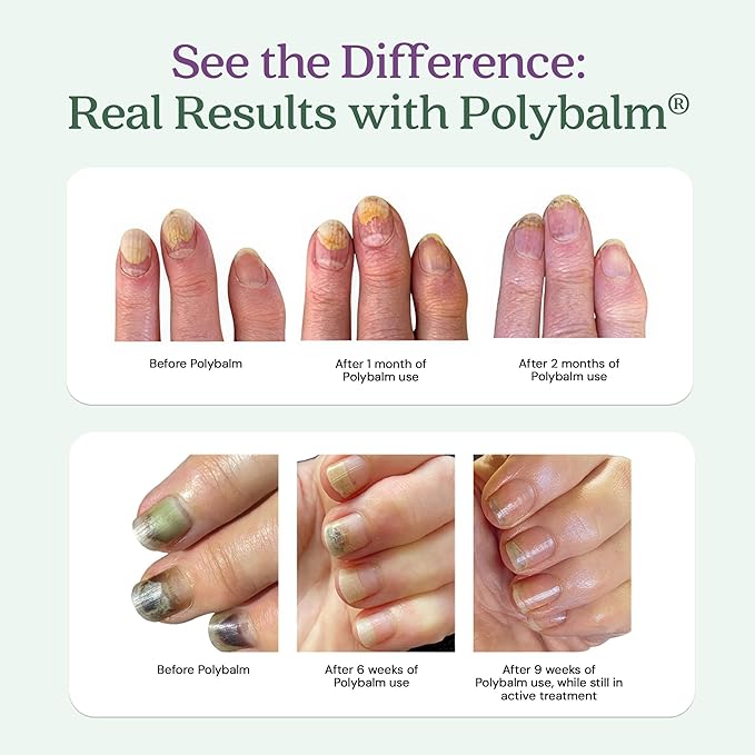 CLINICALLY PROVEN for Weak, Brittle, Damaged Nails | 100% Natural Nail Repair Balm | Doctor Developed to Strengthen Nails Damaged by Gel or Nail Salon Manicures, Menopause & Aging | Made in the UK