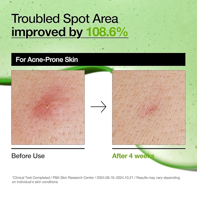 Anua Azelaic Acid 10 Hyaluron Redness Soothing Serum, Facial Serum for Troubled & Sensitive Skin, Breakouts, Hyaluronic Acid, Niacinamide, Spot Care, Natural Color, Korean Skincare (30ml/ 1.01 fl oz.)