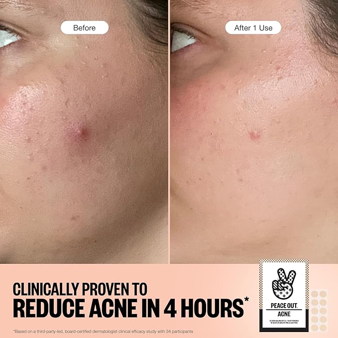 PEACE OUT Acne Healing Dots Helps Clear Blemishes Overnight, Fast Acting Hydrocolloid Pimple Patches for Breakouts with Salicylic Acid, Retinol and Aloe Vera, Award Winning Skincare Solution 10 Count