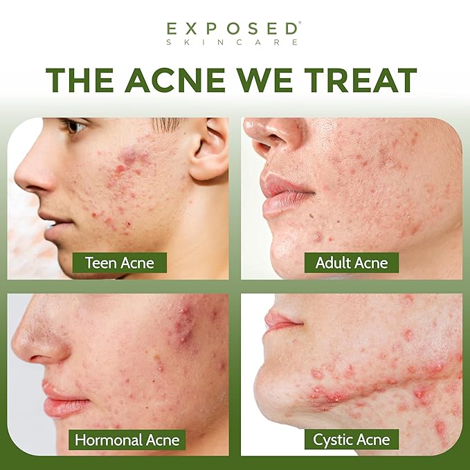 Exposed Skin Care, Acne Facial Cleanser with 0.5% Salicylic Acid for Sensitive and Acne-Prone Skin – Gentle Daily Face Wash for Breakout, Blackhead and Excess Oil – Natural, Non-toxic and Cruelty Free