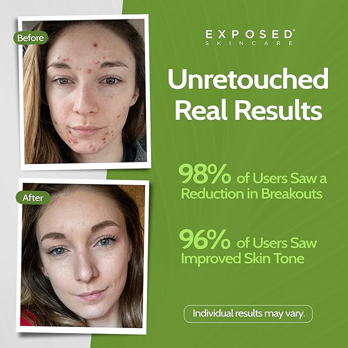 Exposed Skin Care, Clear Pore Serum with 1% Salicylic Acid for Sensitive and Oily Skin – Gently Clears Blackheads, Minimizes Pores and Reduces Excess Oil – Natural, Non-toxic and Cruelty Free