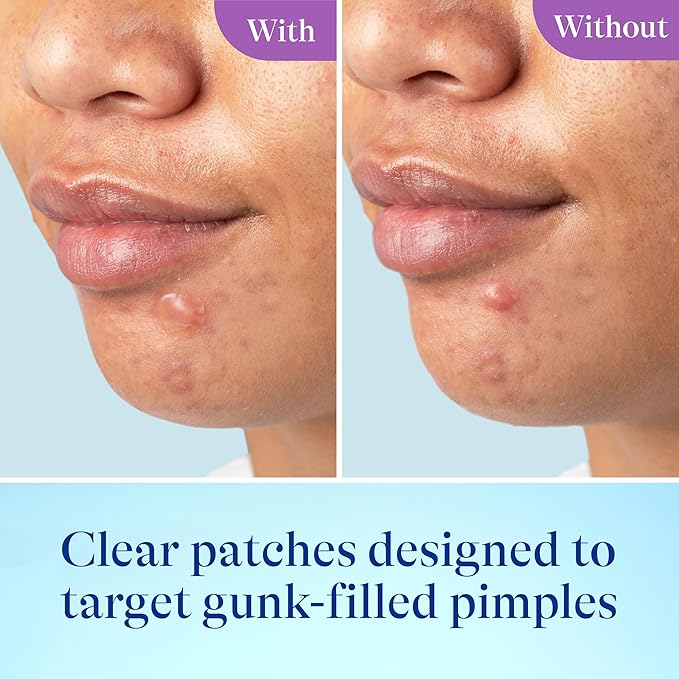 Differin Power Patches for White Head Pimples, Hydrocolloid Patches formulated with Zinc Hyaluronate and Niacinamide, 4-in-1 Hydrotech™ Formula, Helps Absorb Impurities and Restore Skin, 23 ct