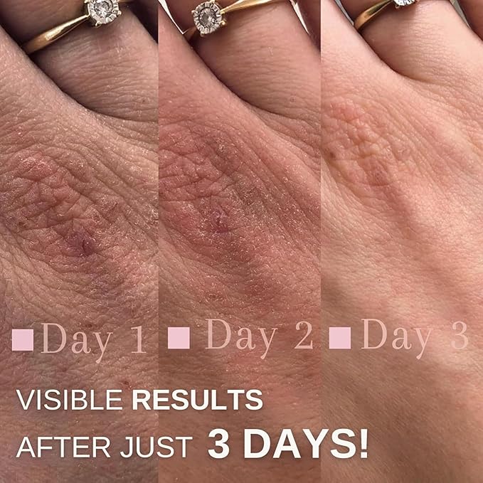 swederm Hudsalva Hand Cream for Women 1.69 Oz - Healing Ointment for Dry Skin with Vitamin E - Hands and Foot Cream - Full Body Moisturizer for Skin Care - Quickly Absorb - Made in Sweden - Pink