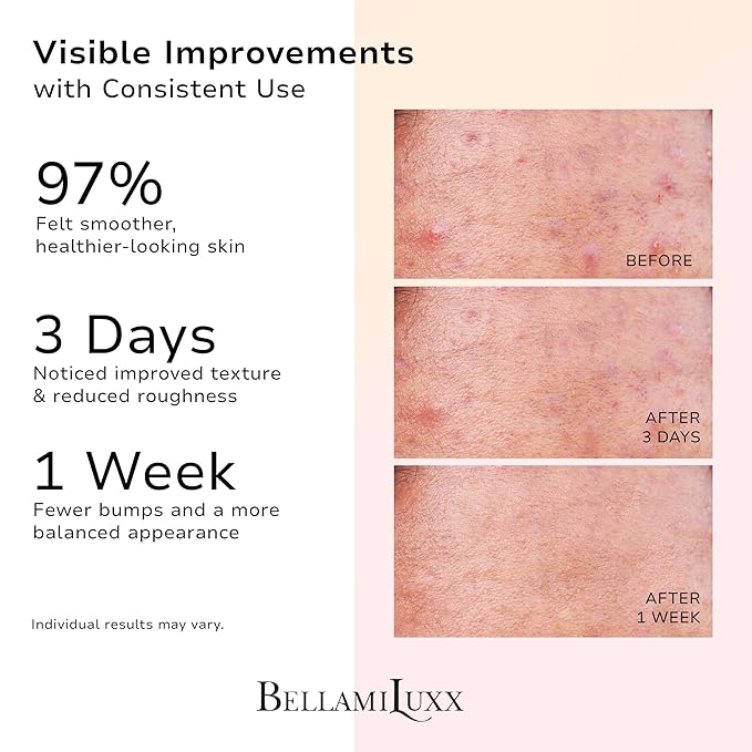 Butt Acne Treatment Set: Acne Soap Bar + Butt Treatment Lotion for Breakouts on Buttocks, Thighs, Back, Chest & Ingrown-Prone & Folliculitis-Prone Skin – Helps Reduce Body Breakouts