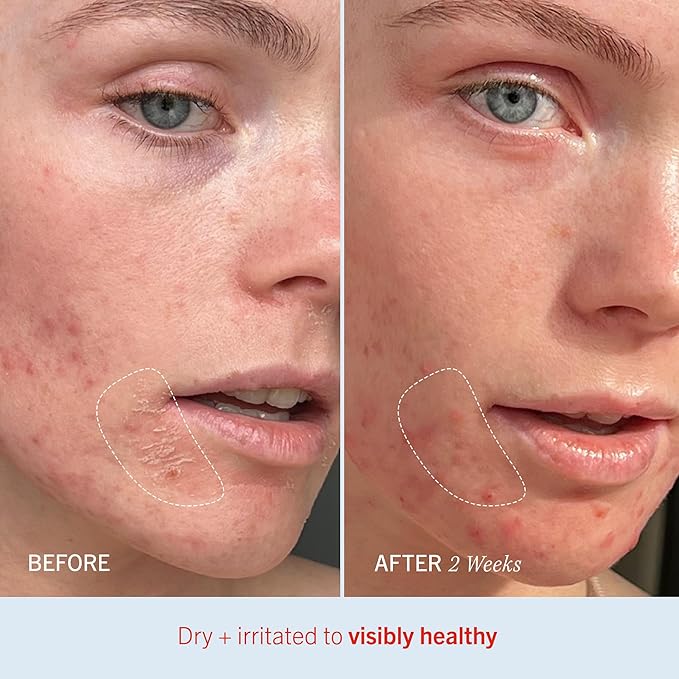 First Aid Beauty - Ultra Repair Cream, Intense Hydration Whipped Colloidal Oatmeal, Clinically Proven to Strengthen Skin Barrier in 7 Days & Helps Relieve Eczema, Luxury Face & Body Moisturizer, 6 oz