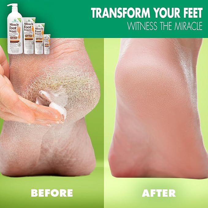 Miracle Foot Repair Cream (1 oz / 12 Pack) Repairs Dry Cracked Heels and Feet, 60% Pure Ultra Aloe Moisturizes, Softens, and Repairs