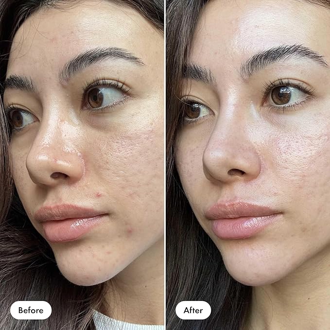 Hero Cosmetics Pimple Correct Acne Clearing Gel Pen - Maximum Strength 2% Salicylic Acid, Derm-Tested Formula for Current and Future Zits (1 Count)