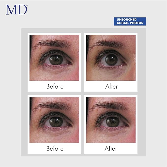 MD Ultimate Eye Cream – Under Eye Cream for Reduced Dark Circles, Puffiness, Wrinkles, Bags & Anti-Aging – Enriched with Collagen, Peptides, Shea Butter for Firmness, Lifting & Moisturization