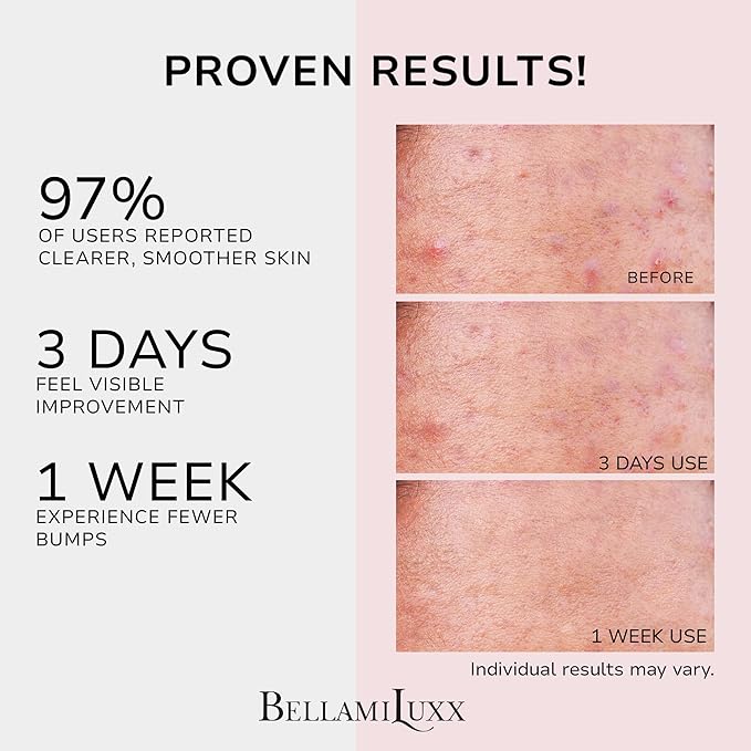 Butt Acne Clearing Treatment Cream: Body Acne Treatment for Folliculitis and Pimples on Buttocks, Thighs, and Body with 2% Salicylic Acid & Tea Tree Oil - Butt Cream for Smooth Skin