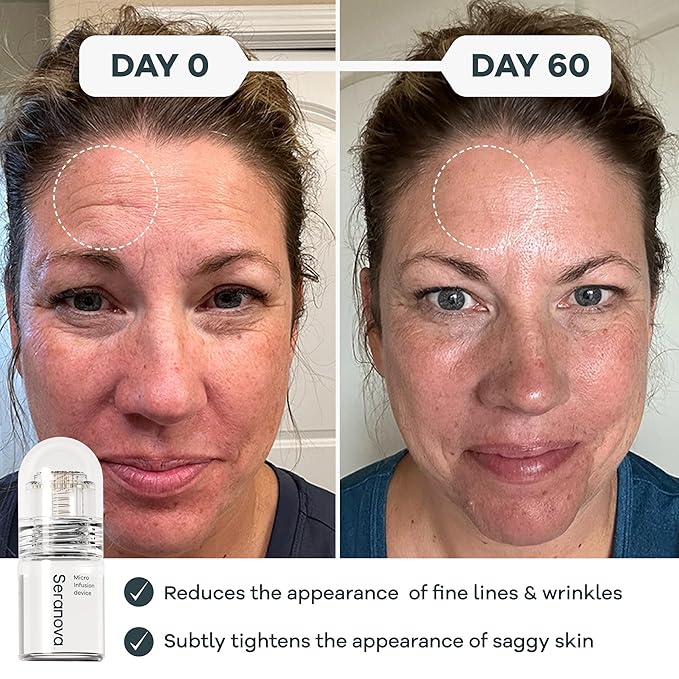 Seranova Micro Infusion System for Face & Neck 0.05mm Stamp with Hyaluronic Acid & Collagen Peptide Serum for Firmer Smoother-Looking Skin, Easy 5-Minute At-Home Skin Care Application - 2 Month Supply